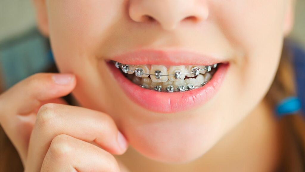 Dental Braces